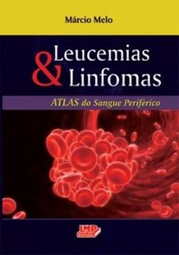 Imagem de LEUCEMIAS E LINFOMAS