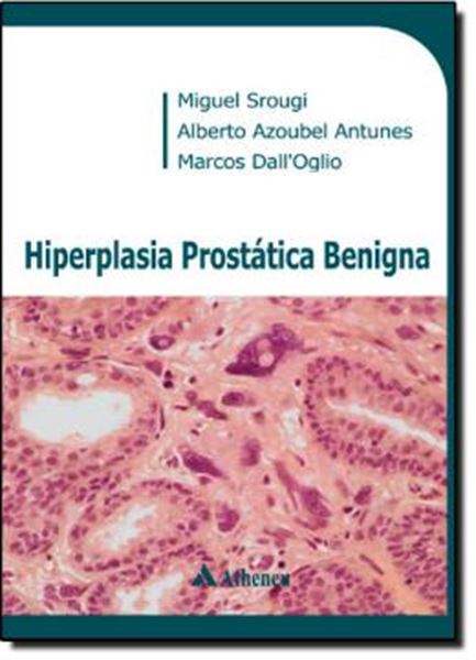 Picture of HIPERPLASIA PROSTATICA BENIGNA