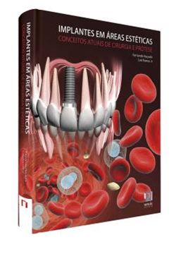 Imagem de IMPLANTES EM AREAS ESTETICAS - CONCEITOS ATUAIS DE CIRURGIA E PROTESE