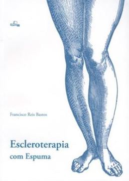Imagem de ESCLEROTERAPIA COM ESPUMA