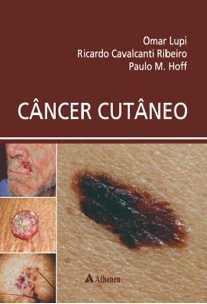 Picture of CANCER CUTANEO