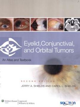 Imagem de EYELID,  CONJUNCTIVAL, AND ORBITAL TUMORS - 2ND ED