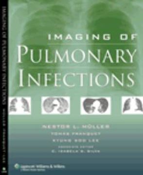 Imagem de IMAGING OF PULMONARY INFECTIONS