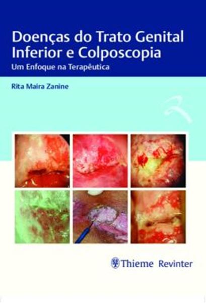 Picture of DOENCAS DO TRATO GENITAL INFERIOR E COLPOSCOPIA - UM ENFOQUE NA TERAPEUTICA