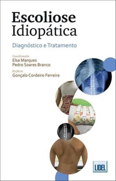 Picture of ESCOLIOSE IDIOPATICA - DIAGNOSTICO E TRATAMENTO
