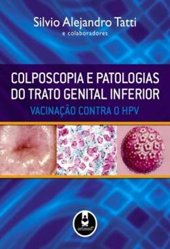 Imagem de COLPOSCOPIA E PATOLOGIAS DO TRATO GENITAL INFERIOR - VACINACAO CONTRA O HPV