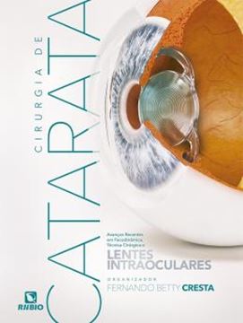 Imagem de CIRURGIA DE CATARATA - AVANCOS RECENTES EM FACODINAMICA, TECNICA CIRURGICA E LENTES INTRAOCULARES