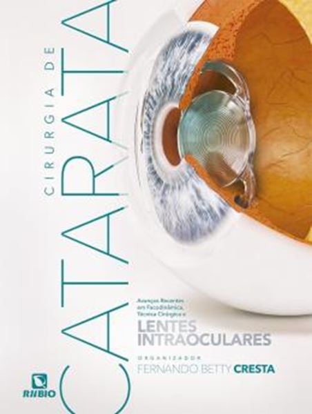 Picture of CIRURGIA DE CATARATA - AVANCOS RECENTES EM FACODINAMICA, TECNICA CIRURGICA E LENTES INTRAOCULARES