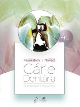Imagem de CARIE DENTARIA: FISIOPATOLOGIA E TRATAMENTO